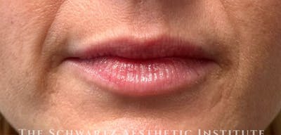 Lip Enhancement Before & After Gallery - Patient 199190 - Image 1
