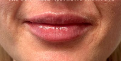 Lip Enhancement Before & After Gallery - Patient 199190 - Image 2