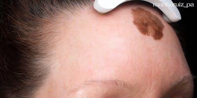 Laser Resurfacing Before & After Gallery - Patient 180832 - Image 1