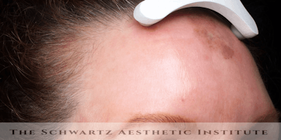 Laser Resurfacing Before & After Gallery - Patient 180832 - Image 2