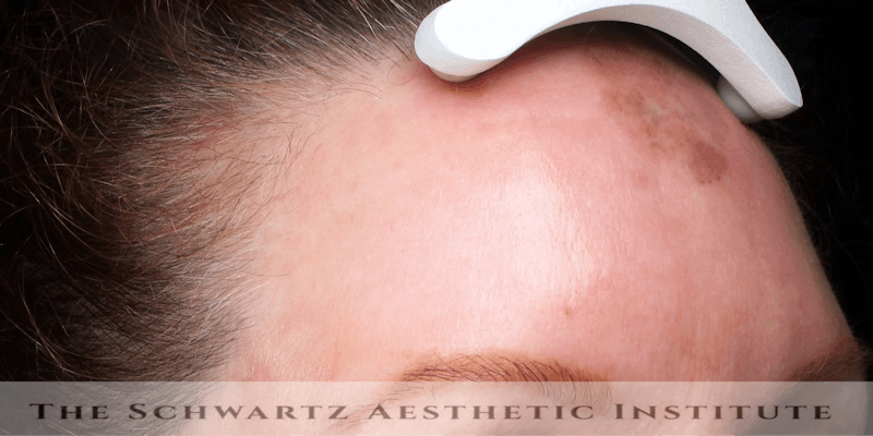 Laser Resurfacing Before & After Gallery - Patient 180832 - Image 2