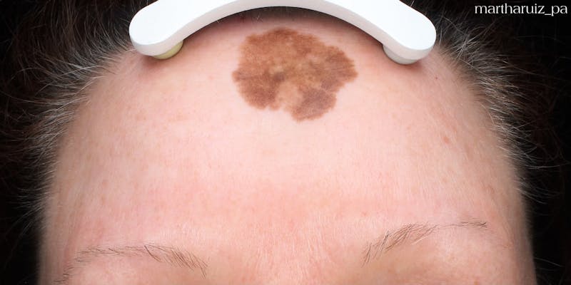 Laser Resurfacing Before & After Gallery - Patient 180832 - Image 3