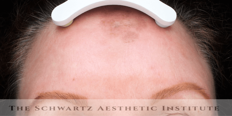 Laser Resurfacing Before & After Gallery - Patient 180832 - Image 4