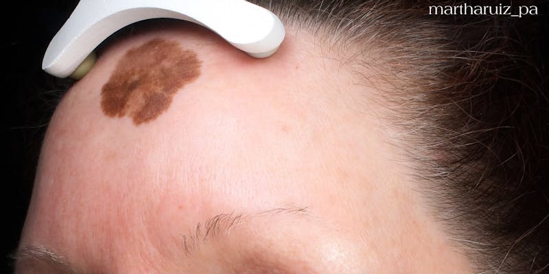 Laser Resurfacing Before & After Gallery - Patient 180832 - Image 5