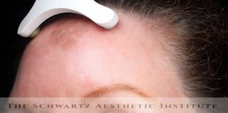 Laser Resurfacing Before & After Gallery - Patient 180832 - Image 6