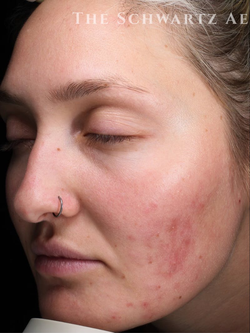 Laser Resurfacing Before & After Gallery - Patient 772704 - Image 1