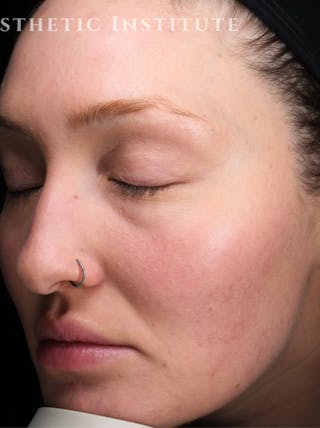 Laser Resurfacing Before & After Gallery - Patient 772704 - Image 2
