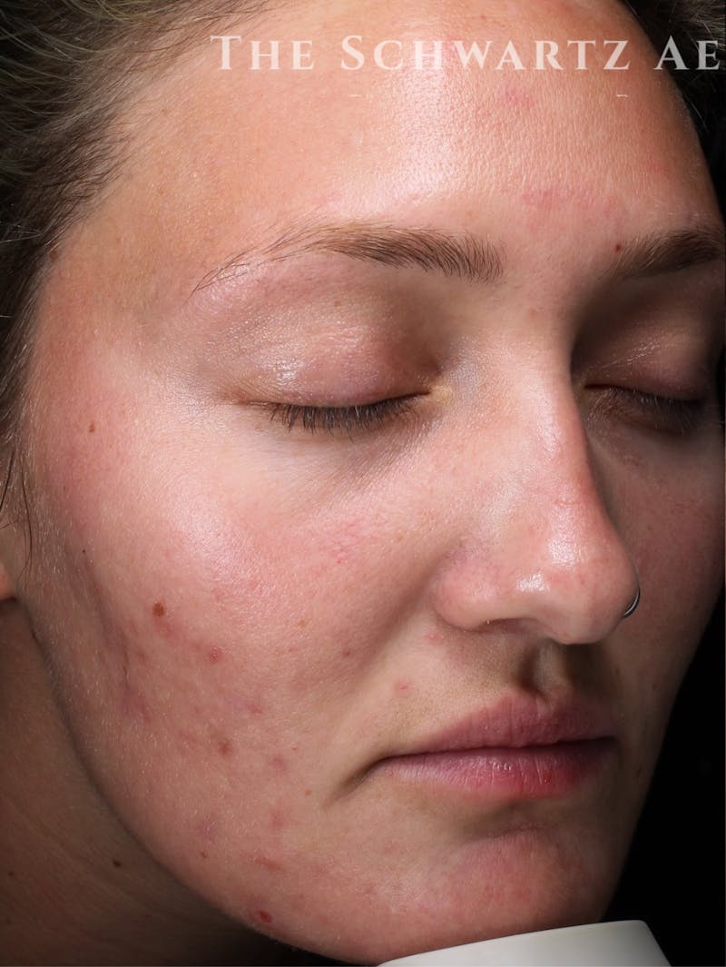 Laser Resurfacing Before & After Gallery - Patient 772704 - Image 3