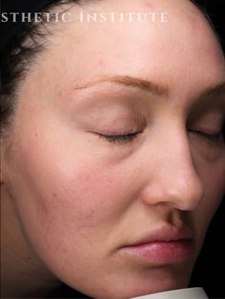 Laser Resurfacing Before & After Gallery - Patient 772704 - Image 4
