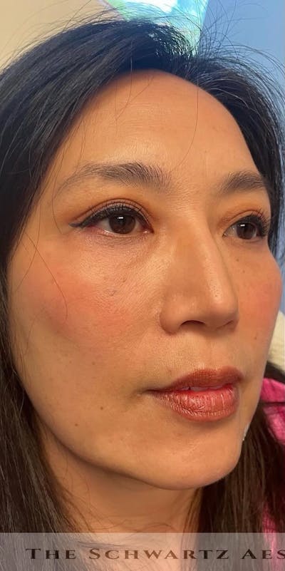 Chin Filler Before & After Gallery - Patient 172911 - Image 1