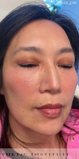 Chin Filler Before & After Gallery - Patient 172911 - Image 2