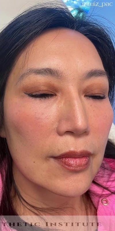 Chin Filler Before & After Gallery - Patient 172911 - Image 2
