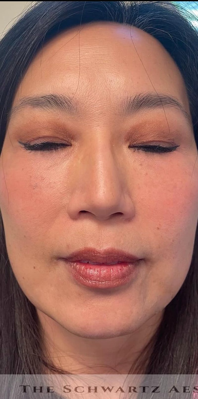 Chin Filler Before & After Gallery - Patient 172911 - Image 3