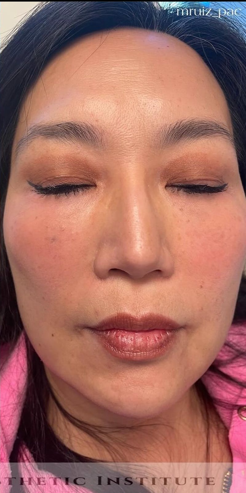 Chin Filler Before & After Gallery - Patient 172911 - Image 4