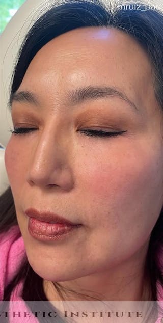 Chin Filler Before & After Gallery - Patient 172911 - Image 6