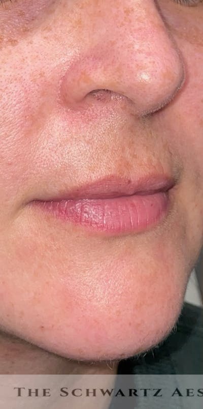 Lip Enhancement Before & After Gallery - Patient 799032 - Image 1