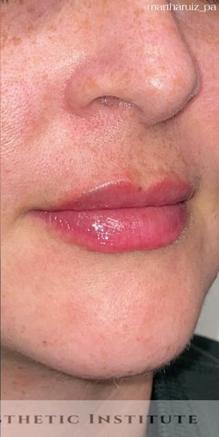 Lip Enhancement Before & After Gallery - Patient 799032 - Image 2