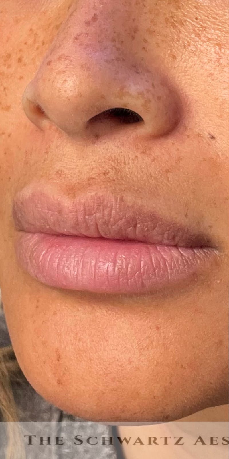 Lip Enhancement Before & After Gallery - Patient 314219 - Image 1