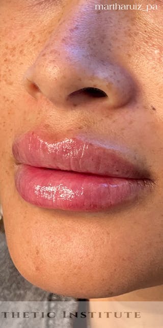 Lip Enhancement Before & After Gallery - Patient 314219 - Image 2