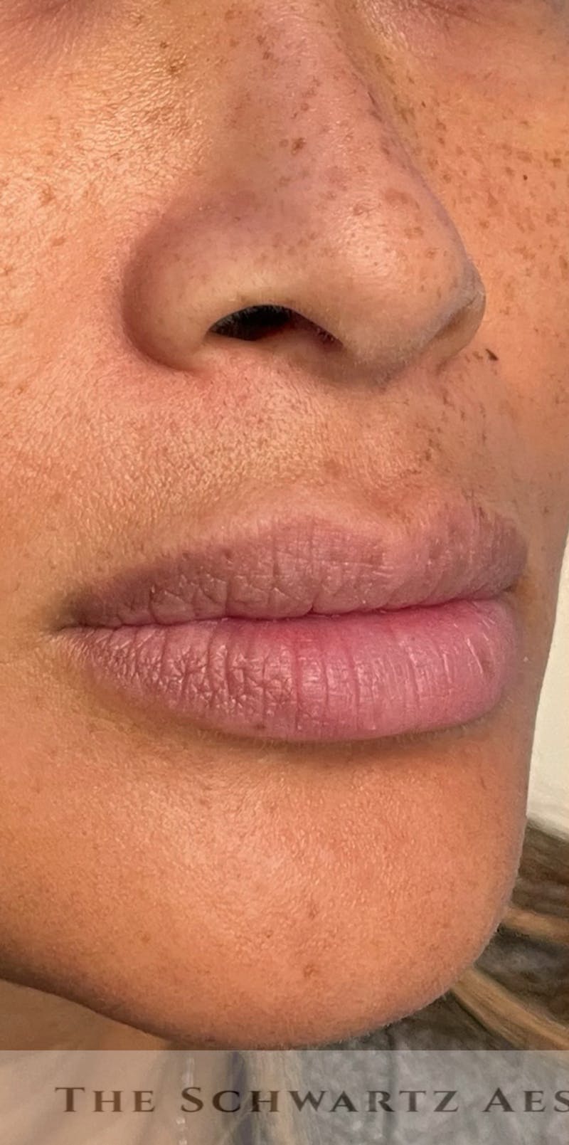Lip Enhancement Before & After Gallery - Patient 314219 - Image 3