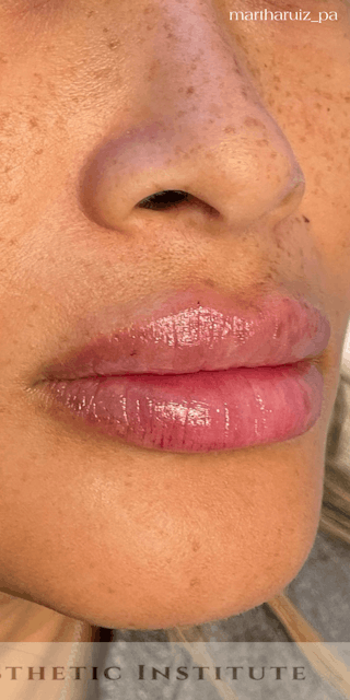 Lip Enhancement Before & After Gallery - Patient 314219 - Image 4
