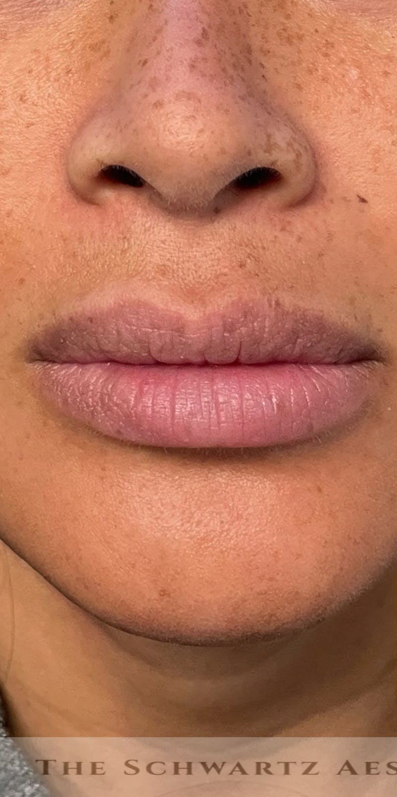 Lip Enhancement Before & After Gallery - Patient 314219 - Image 5