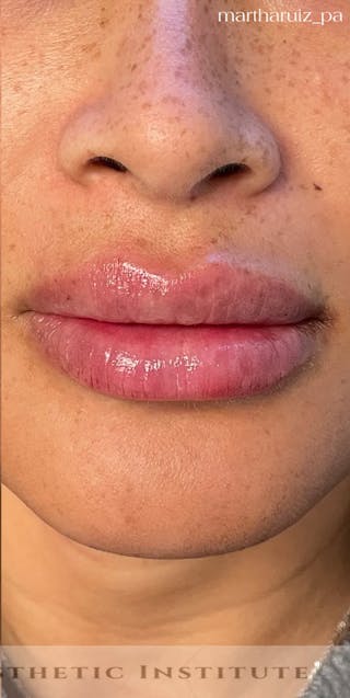Lip Enhancement Before & After Gallery - Patient 314219 - Image 6