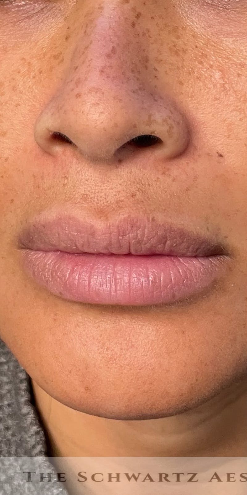 Lip Enhancement Before & After Gallery - Patient 314219 - Image 7