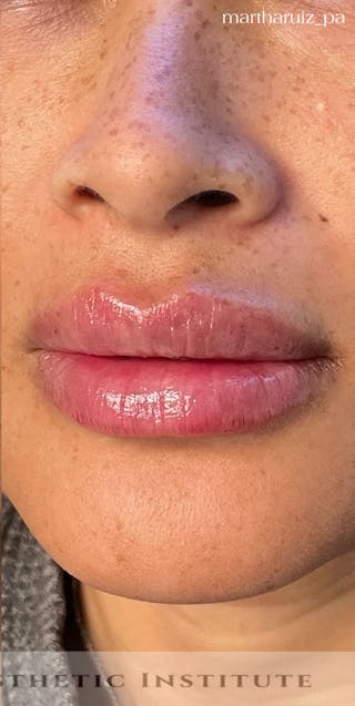 Lip Enhancement Before & After Gallery - Patient 314219 - Image 8
