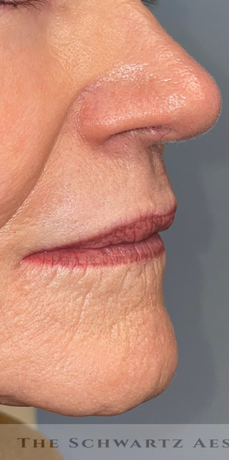 Lip Enhancement Before & After Gallery - Patient 324167 - Image 1