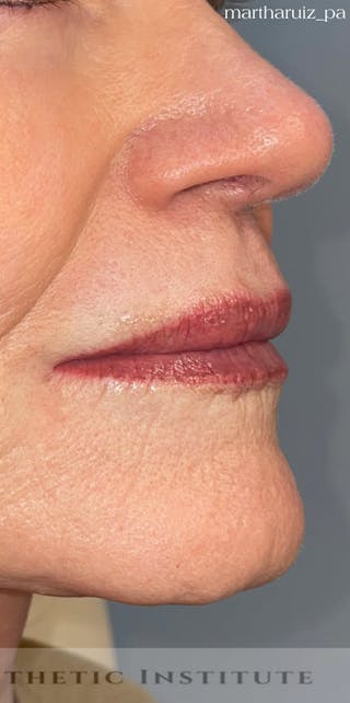 Lip Enhancement Before & After Gallery - Patient 324167 - Image 2