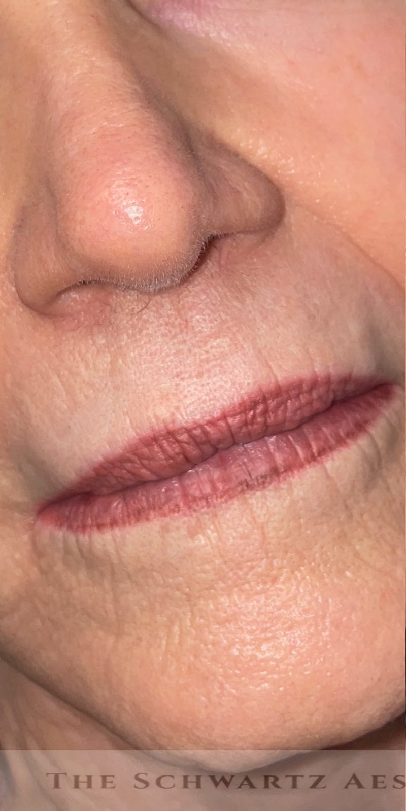 Lip Enhancement Before & After Gallery - Patient 324167 - Image 3