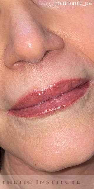 Lip Enhancement Before & After Gallery - Patient 324167 - Image 4