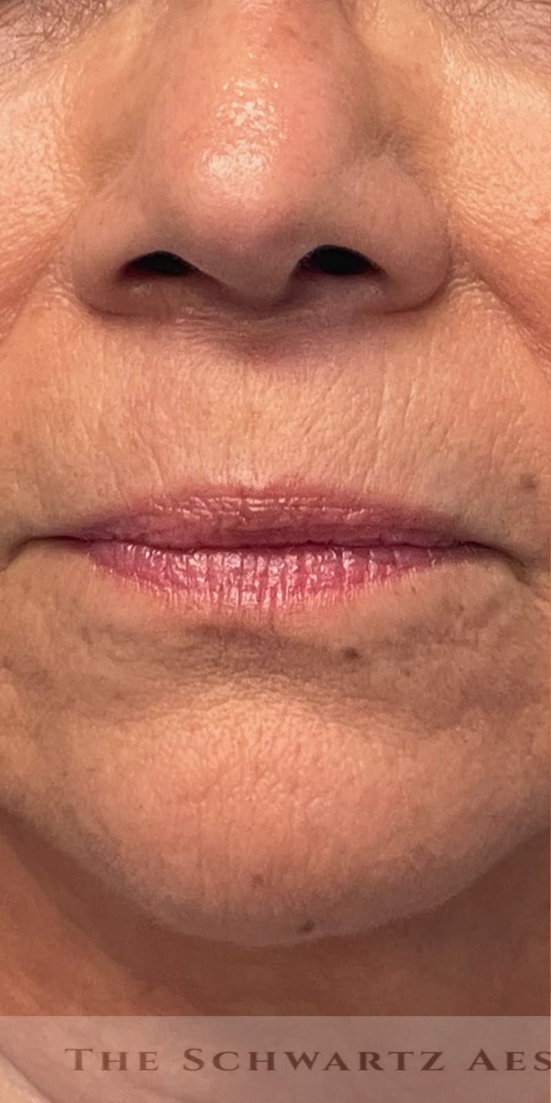 Lip Enhancement Before & After Gallery - Patient 268840 - Image 1