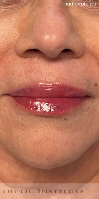 Lip Enhancement Before & After Gallery - Patient 268840 - Image 2