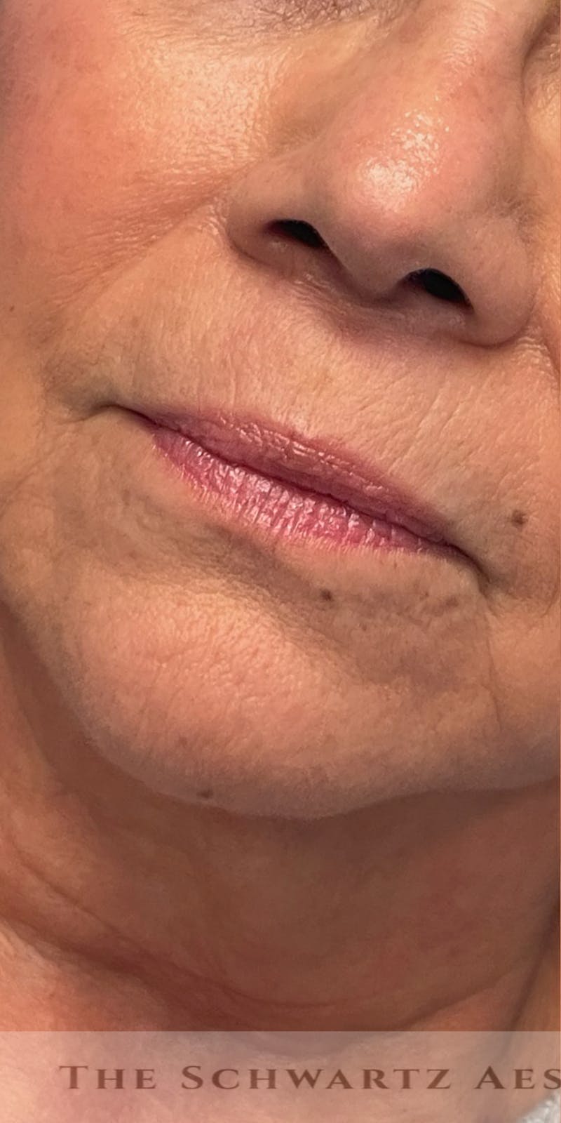 Lip Enhancement Before & After Gallery - Patient 268840 - Image 3
