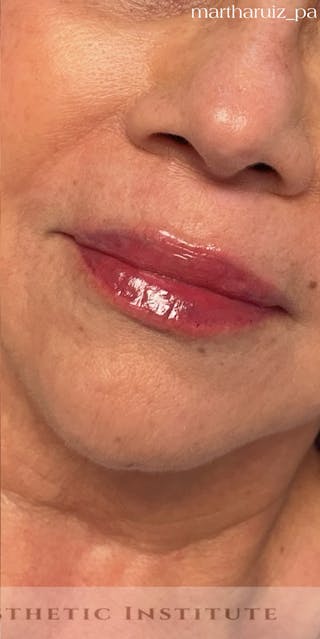 Lip Enhancement Before & After Gallery - Patient 268840 - Image 4