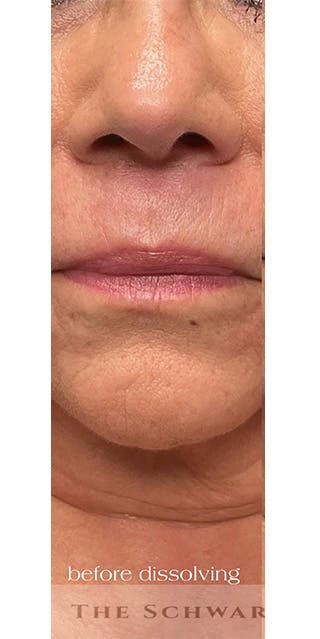 Lip Enhancement Before & After Gallery - Patient 268840 - Image 6