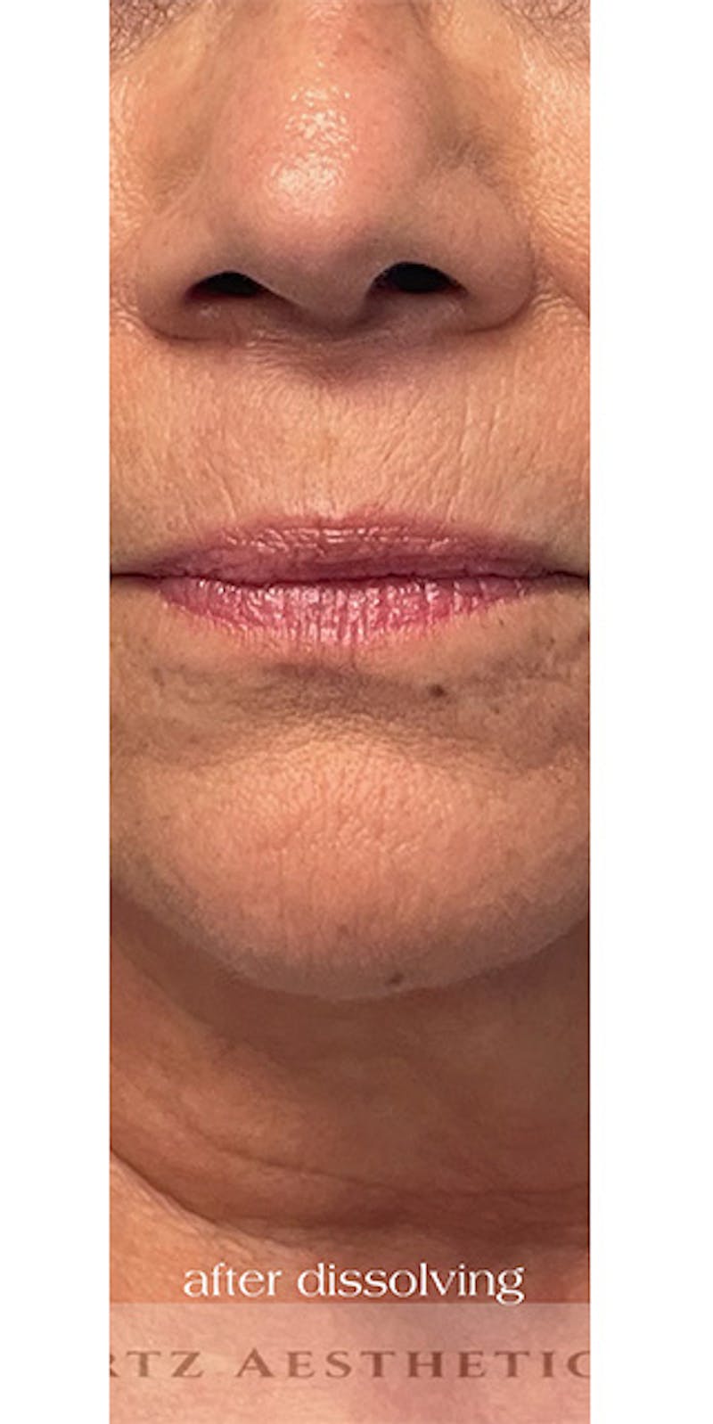Lip Enhancement Before & After Gallery - Patient 268840 - Image 5