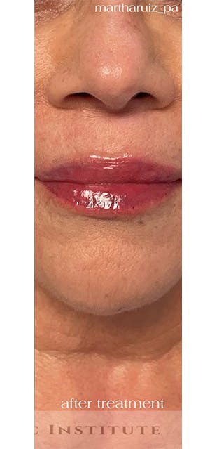 Lip Enhancement Before & After Gallery - Patient 268840 - Image 8