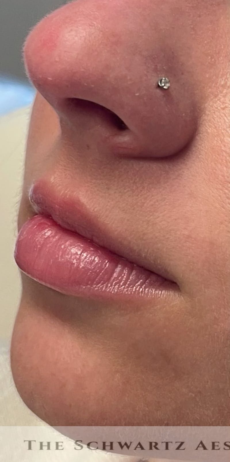 Lip Enhancement Before & After Gallery - Patient 177700 - Image 1
