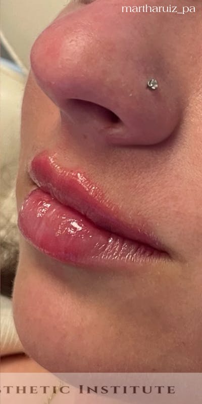 Lip Enhancement Before & After Gallery - Patient 177700 - Image 2