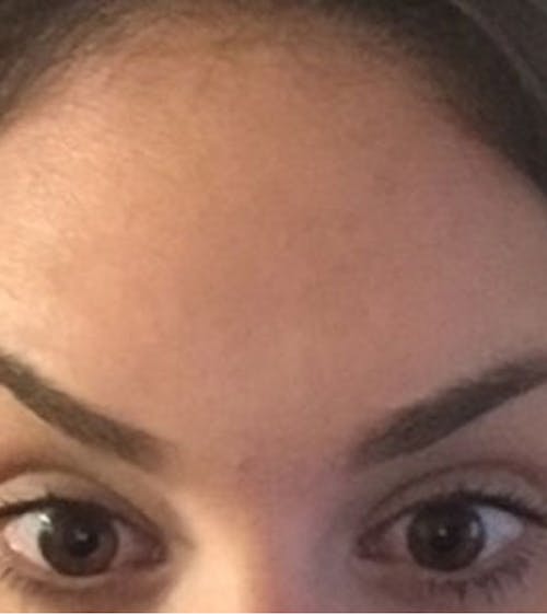 Botox Forehead After