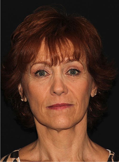 Neck Lift And Facelift image