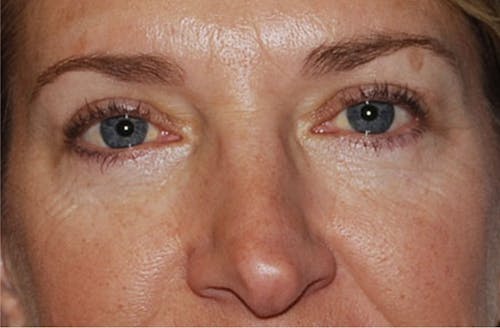 Breast Augmentation image