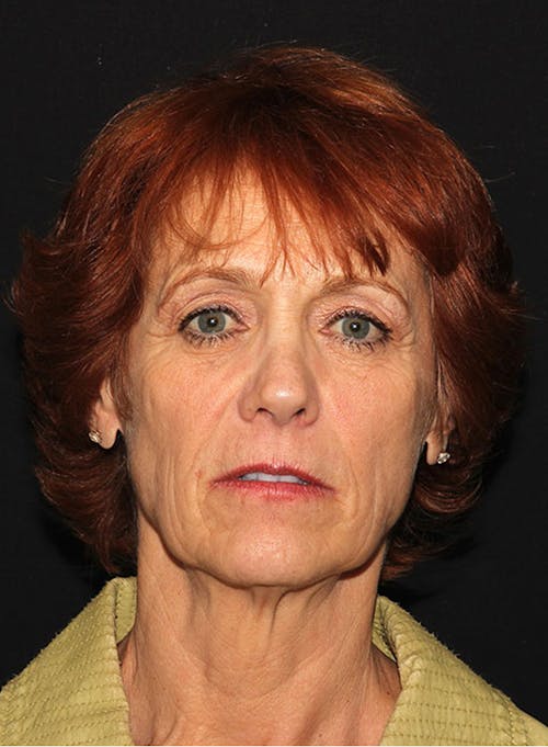 Neck Lift And Facelift image