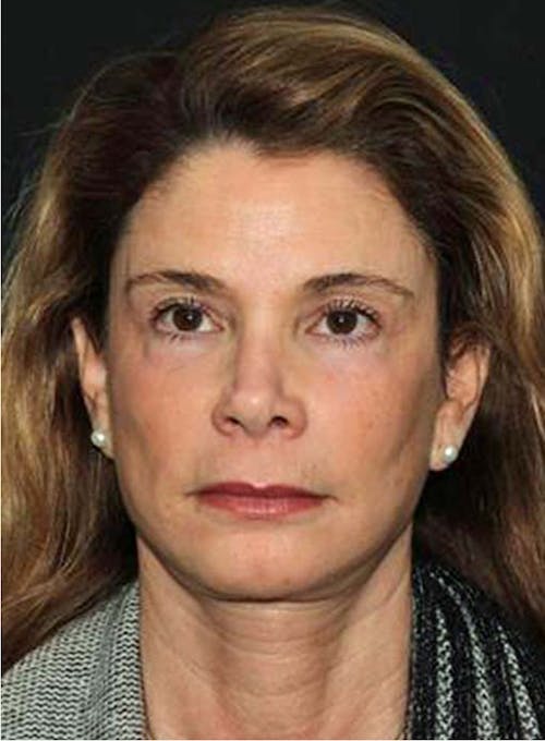 Brow Lift image