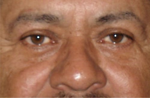 Eyelid Surgery image