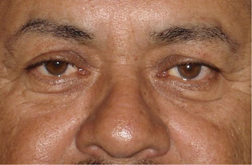 Eyelid Surgery image