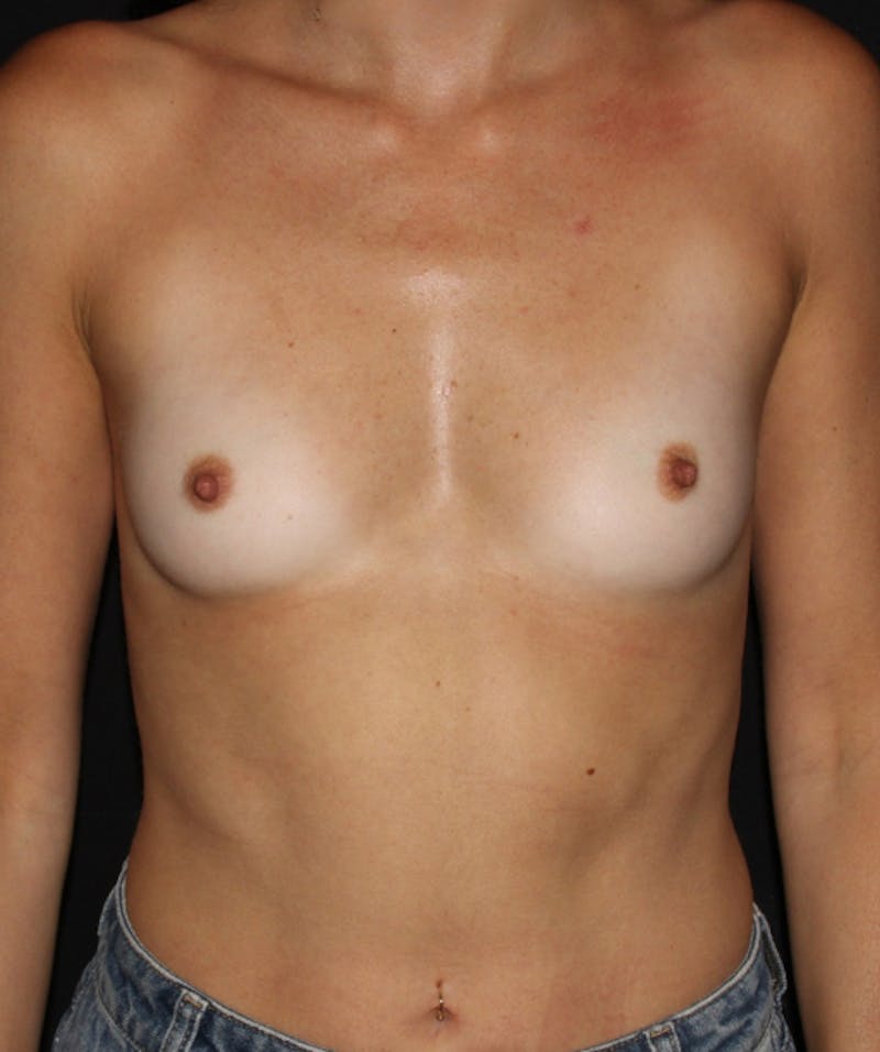Breast Lift with Implants Before & After Gallery - Patient 157917 - Image 1